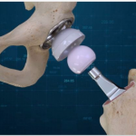 Screen Shot New Hip Replacement Procedure Launches