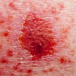 basal cell skin cancer being treated with fluorouracil topical medicine