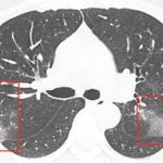 Les images pulmonaires caractéristiques du coronavirus au scanner